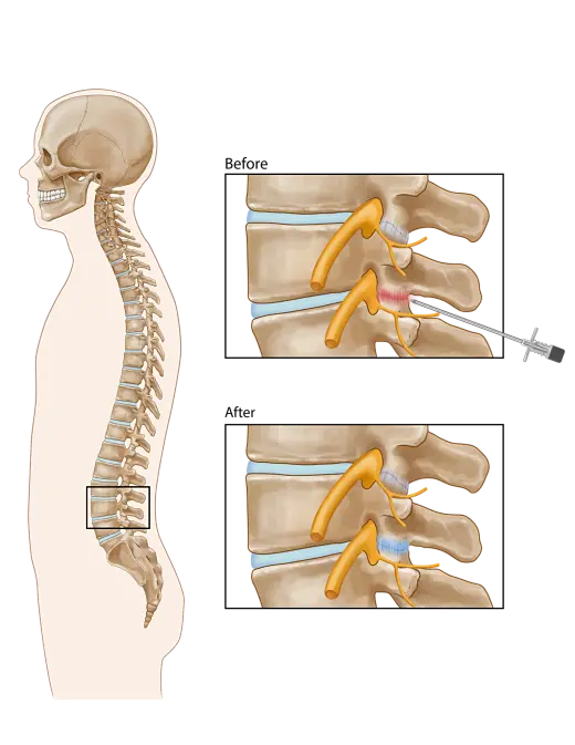 Lumbar Facet Joint Injection opt | Chronic Pain Relief Center