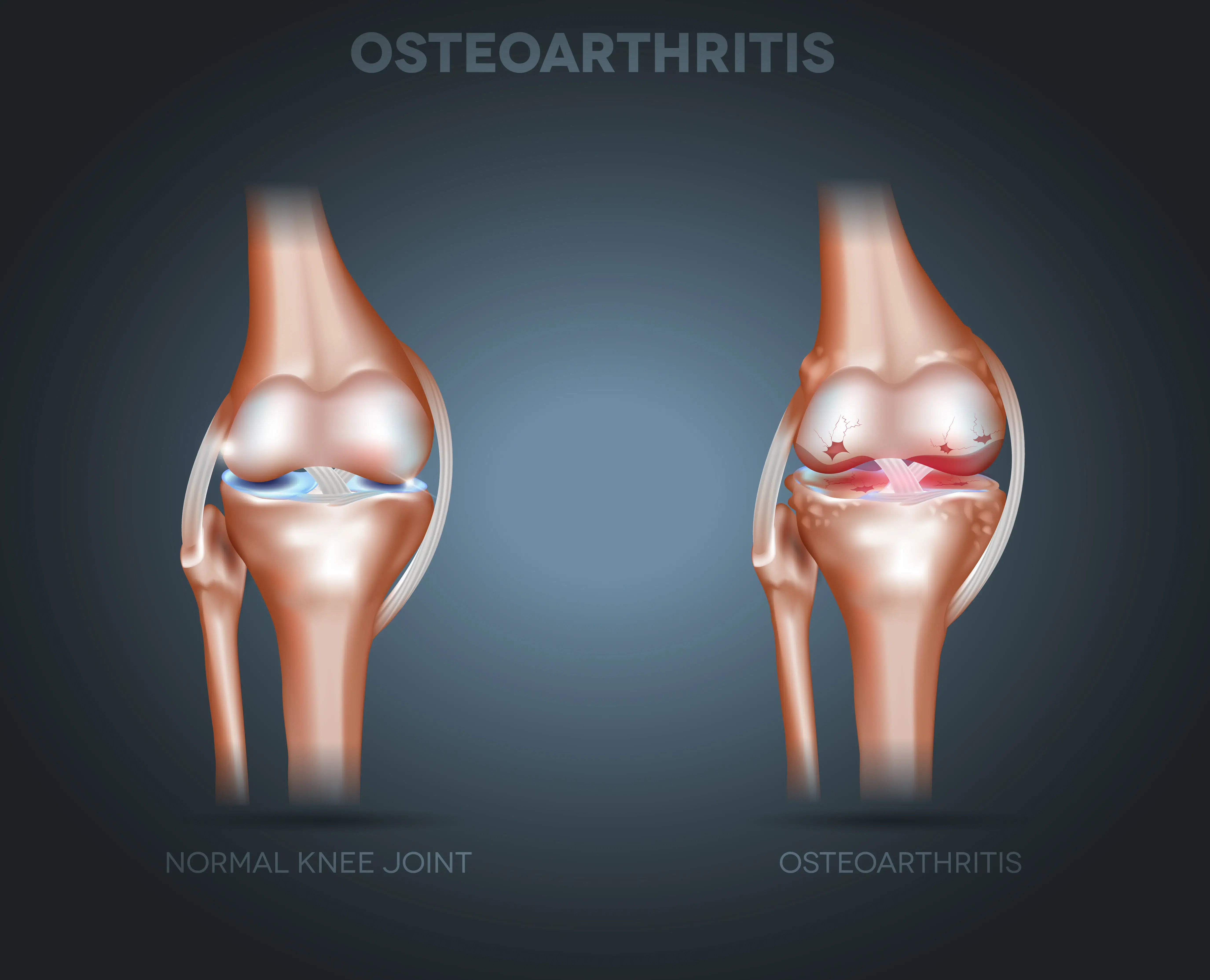 osteoarthritis in knee | Chronic Pain Relief Center